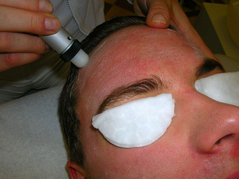 Microdermabrasion